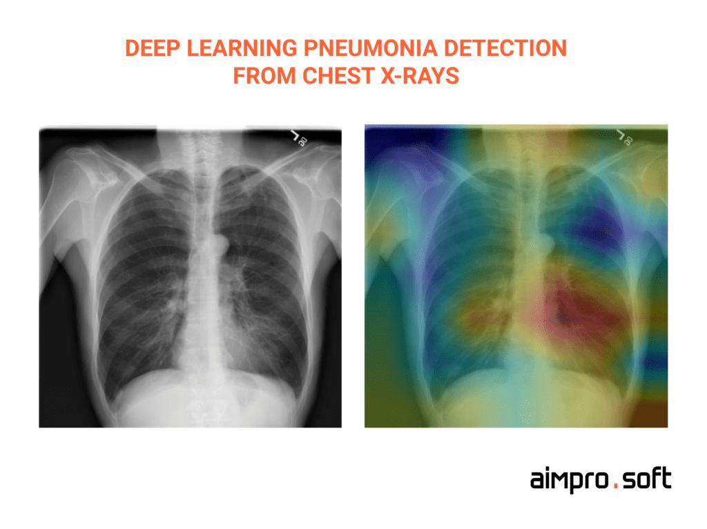 Deep learning pneumonia detection with computer vision from chest x-rays